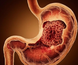 慢性胃發炎不可忽視！五大因子要避免