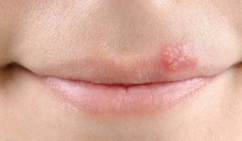 唇皰疹 vs 口角炎，差在哪裡？一次搞懂症狀與成因