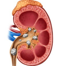 腎結石痛起來真要命！哪些人屬於高危險群？