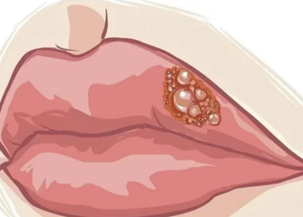 火氣大狂嘴破 該怎麼做怎麼吃改善？