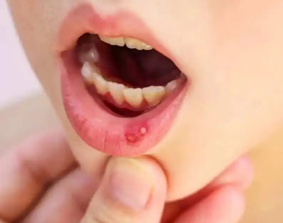 嘴破等於「上火」嗎？專家解析三種常見原因