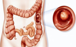 從血便辨別直腸癌與痔瘡：早期警示不可忽視