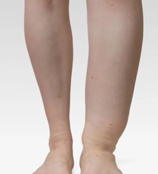 為什麼會水腫？醫師與營養師完整解析