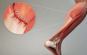 延遲性肌肉痠痛（DOMS）三招恢復、三招共處！