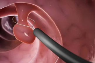 四大壞習慣易導致息肉體質