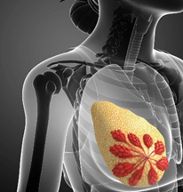 五個壞習慣，讓乳房纖維腺瘤找上門！