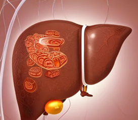 脂肪肝的九大症狀，你注意到了嗎？