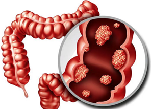 大腸癌與飲食習慣密切相關，你吃對了嗎？