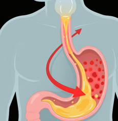 胃食道逆流該怎麼吃？專家營養建議大公開