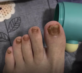 為什麼會有灰指甲？專業醫師解析與改善方法