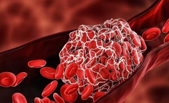 小心腦栓塞！血太濃稠四大警訊＋六種食物降低血液黏稠