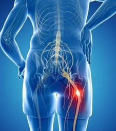 坐骨神經痛受不了？舒緩不適感的四大招