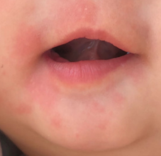 這些食物過敏原你中了嗎？教你這樣挑選低敏食物