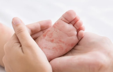 麻疹症狀、預防方式一次看