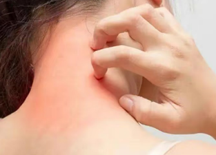 蕁麻疹纏身？低組織胺飲食幫你降火