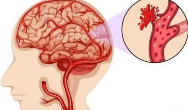 撞到頭別輕忽！腦出血8大警訊，你中了幾個？