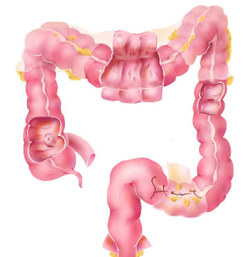 大腸癌高危族群警示！八大危險因子你中了幾項？