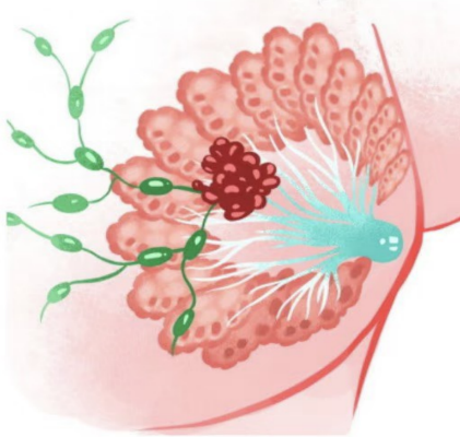 乳癌高危因子一次看懂！這15個因素你一定要注意