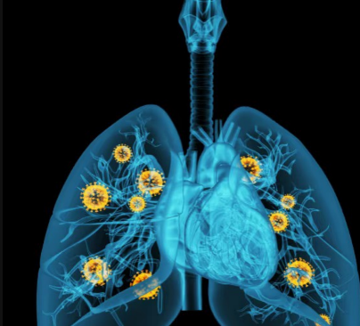 肺腺癌其實離你我很近：日常這樣吃＋這樣做，遠離沉默殺手！