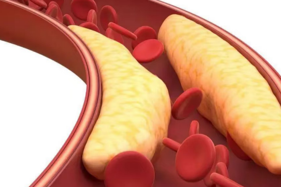 年輕又不胖，為什麼會高血脂？降血脂飲食這樣調整