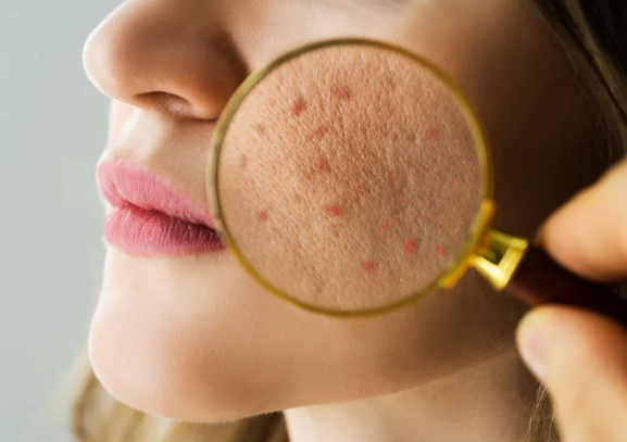 痘痘好困擾？專業團隊告訴你這樣做！