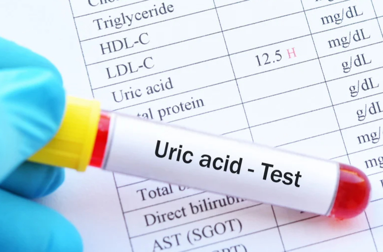 痛風/結石警報！尿酸結石的「低普林飲食」救命清單