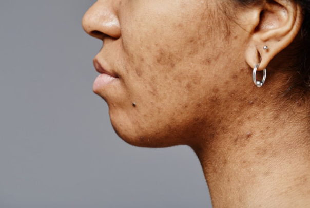 不想留痘疤？掌握這些關鍵步驟！