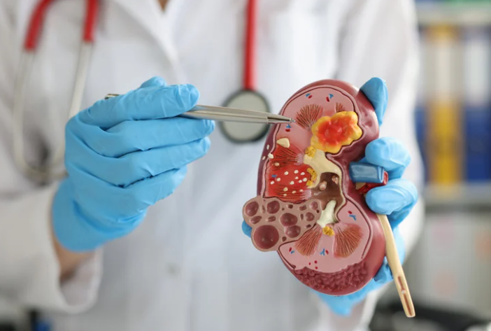 腎結石拉警報！專業醫囑：3招「排石飲食」關鍵，遠離絞痛地獄！