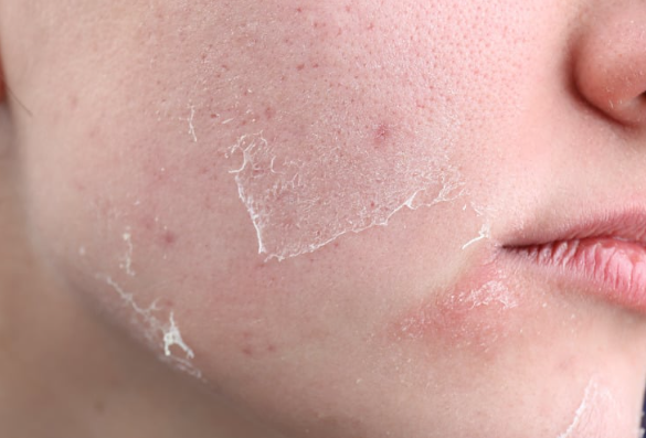 皮膚粗糙？你可能缺維生素A！